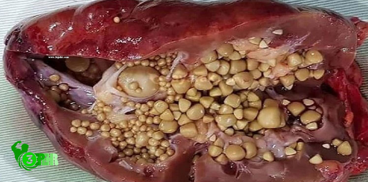 اگر ورزش نکنی می میری!!! ، بیماری های قلبی ، سنگ کلیه